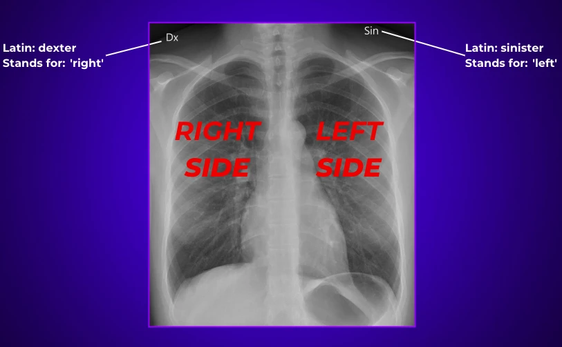 left and right sides of a chest X-ray