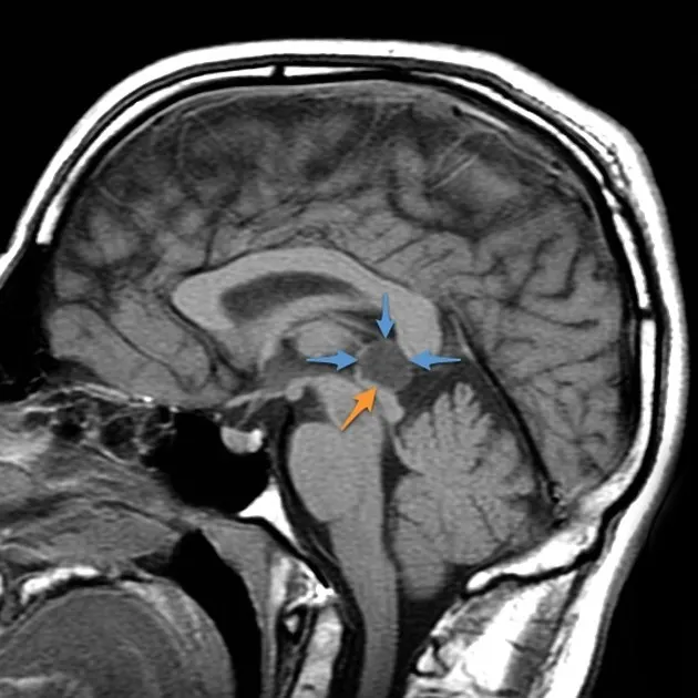 Pineal Bez MRI'si
