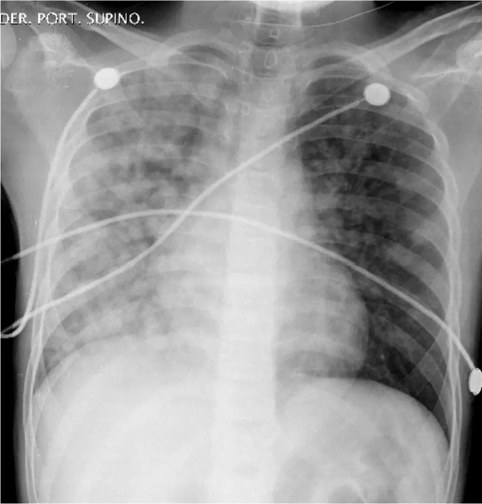 Pulmoner Ödem