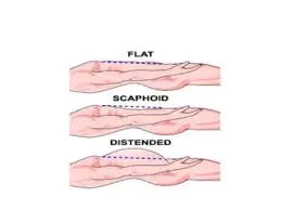 Illustration de l'Abdomen Scaphoïde