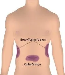 格雷·特納與 Cullen 的徵象比較