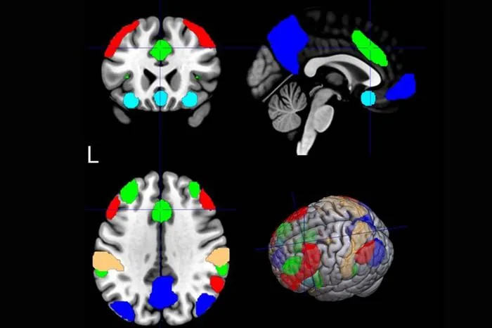 AI and fMRI Power Personalized TMS for Smoking Cessation at MUSC