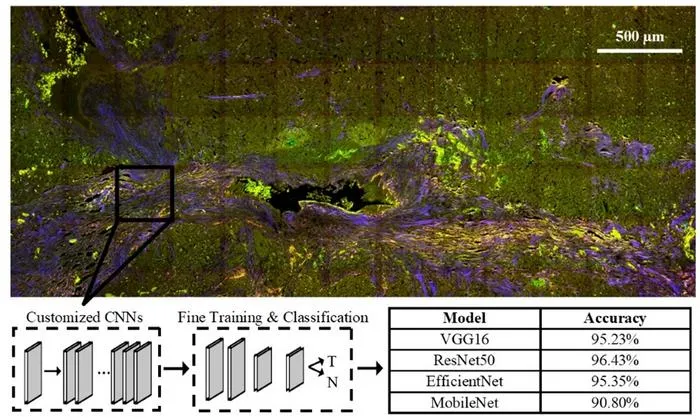 AI and Multiphoton Microscopy Achieve 96% Accuracy in Pancreatic Tumor Detection
