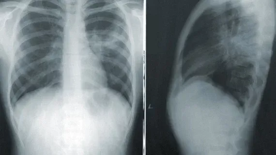 AI Detects Incidental Lung Nodules on Routine Chest X-Rays