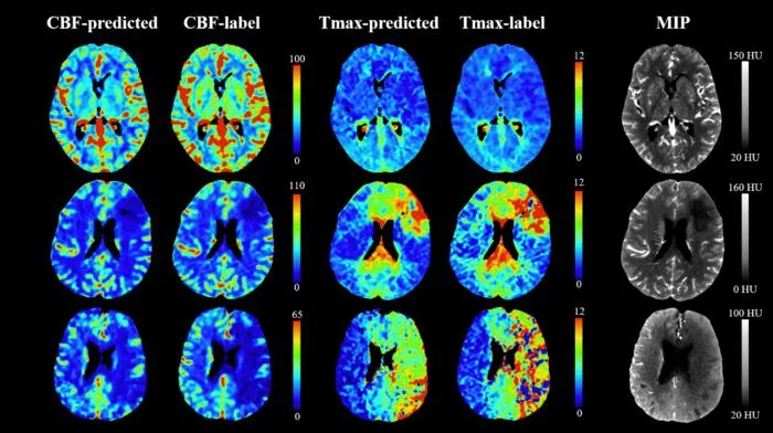 AI Enables Ultra-Low Dose CT Perfusion for Stroke Assessment