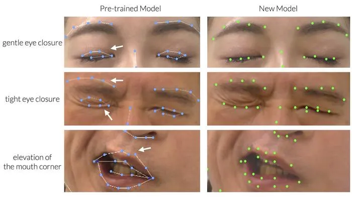 AI Model Advances Automated Video-Based Assessment of Facial Palsy