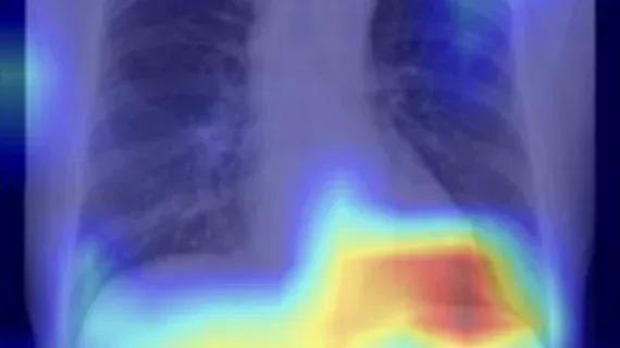 AI Model Detects Fatty Liver Disease on Routine Chest X-rays