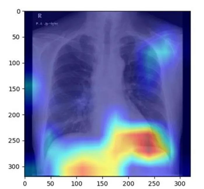 AI Model Uses Chest X-Rays to Detect Fatty Liver Disease