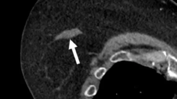 AI More Than Doubles Detection of Incidental Breast Lesions on CT