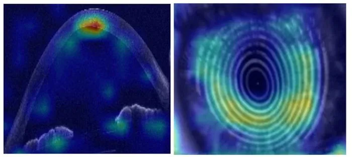 AI Predicts Keratoconus Progression Using OCT Scans