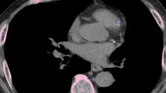 AI Tracks Coronary Calcium Growth on Lung Cancer CT Scans