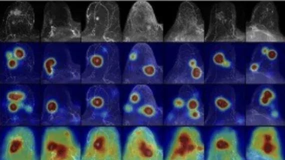 Explainable AI Model Enhances Breast Cancer MRI Detection