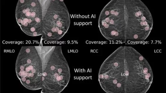 Eye-Tracking Study Shows AI Support Enhances Radiologist Detection in Mammography