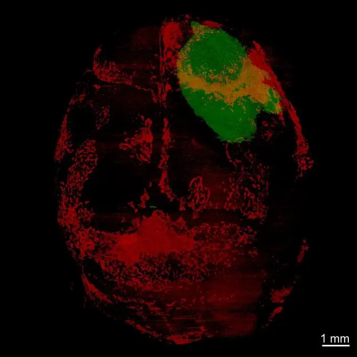 Imaging Reveals Skull Changes and Immune Impact in Glioblastoma