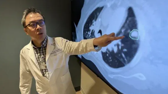 Northwestern Develops iSeg AI for Superior Lung Tumor Segmentation
