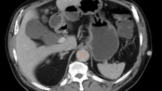 Opportunistic AI Algorithm Enhances AAA Detection on Abdominal CT