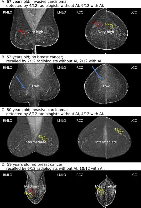 Study Finds AI Boosts Radiologists' Accuracy in Mammogram Readings